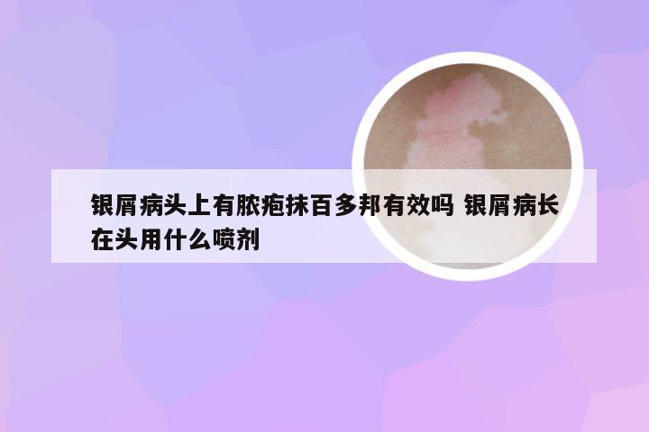 银屑病头上有脓疱抹百多邦有效吗 银屑病长在头用什么喷剂