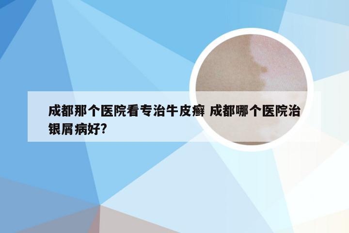 成都那个医院看专治牛皮癣 成都哪个医院治银屑病好?