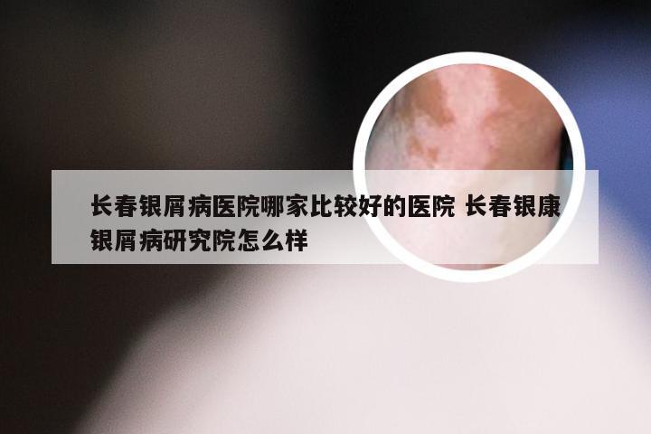 长春银屑病医院哪家比较好的医院 长春银康银屑病研究院怎么样