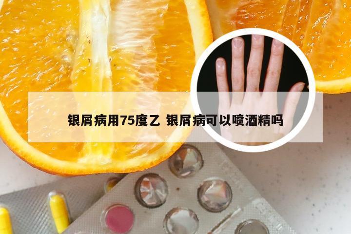 银屑病用75度乙 银屑病可以喷酒精吗