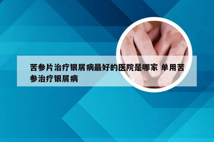 苦参片治疗银屑病最好的医院是哪家 单用苦参治疗银屑病