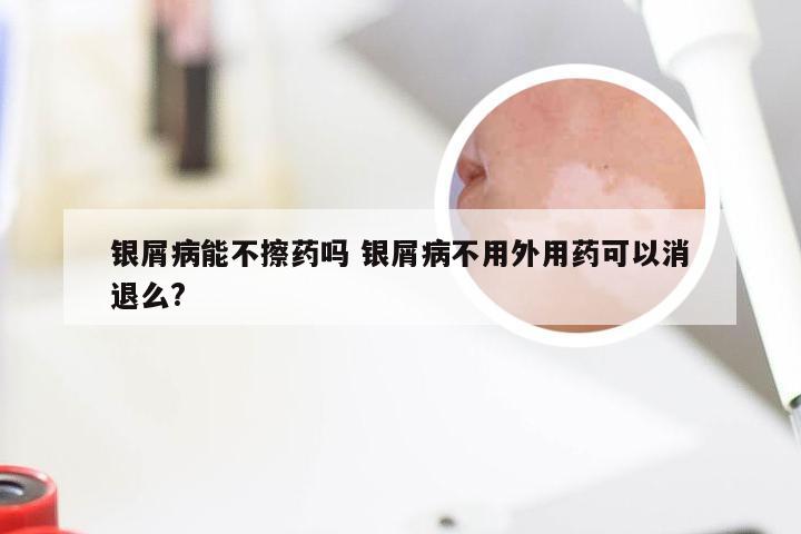 银屑病能不擦药吗 银屑病不用外用药可以消退么?