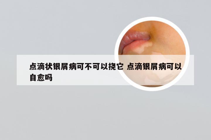 点滴状银屑病可不可以挠它 点滴银屑病可以自愈吗