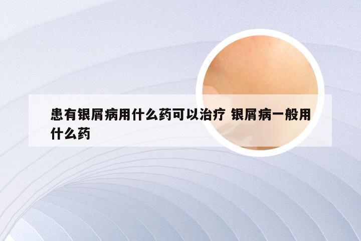 患有银屑病用什么药可以治疗 银屑病一般用什么药