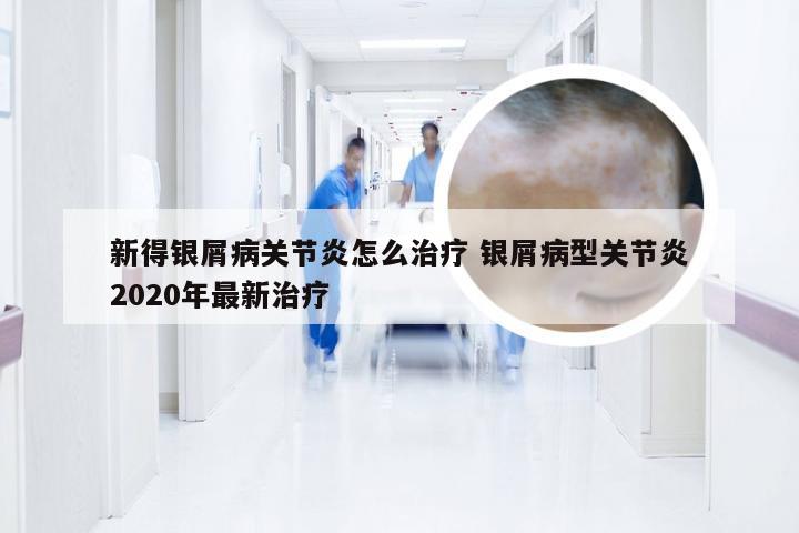 新得银屑病关节炎怎么治疗 银屑病型关节炎2020年最新治疗