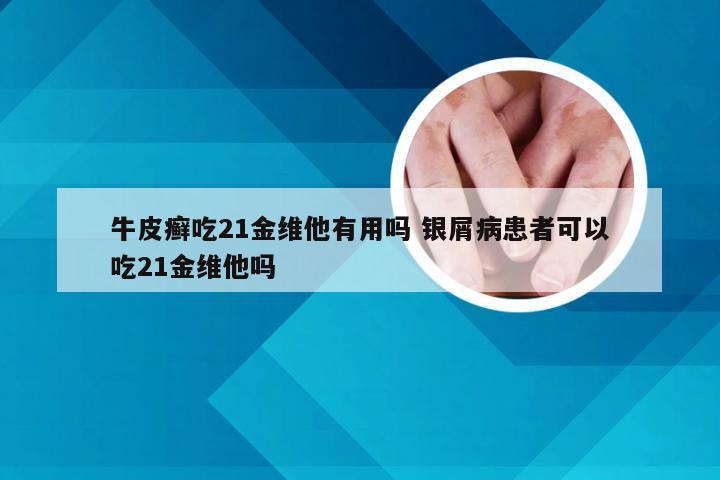 牛皮癣吃21金维他有用吗 银屑病患者可以吃21金维他吗