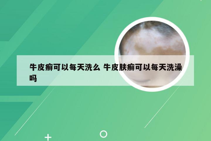 牛皮癣可以每天洗么 牛皮肤癣可以每天洗澡吗