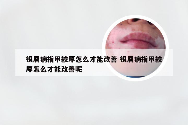 银屑病指甲较厚怎么才能改善 银屑病指甲较厚怎么才能改善呢