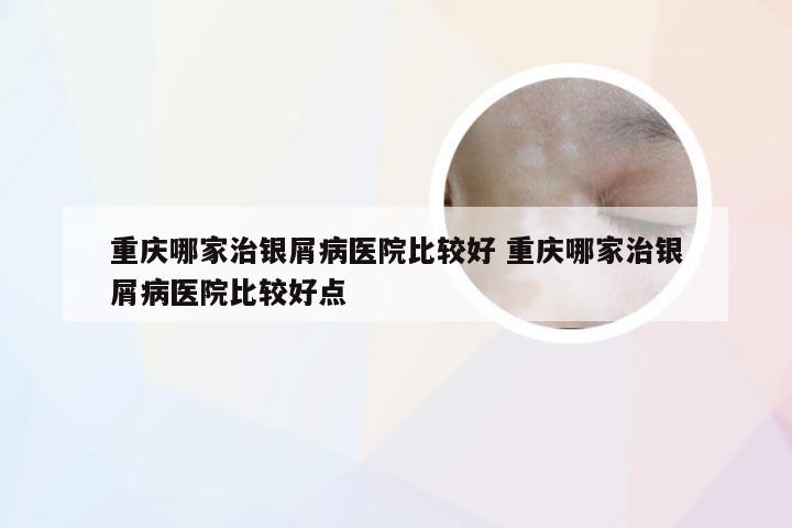 重庆哪家治银屑病医院比较好 重庆哪家治银屑病医院比较好点