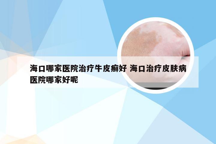 海口哪家医院治疗牛皮癣好 海口治疗皮肤病医院哪家好呢