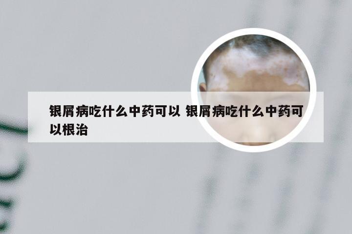 银屑病吃什么中药可以 银屑病吃什么中药可以根治