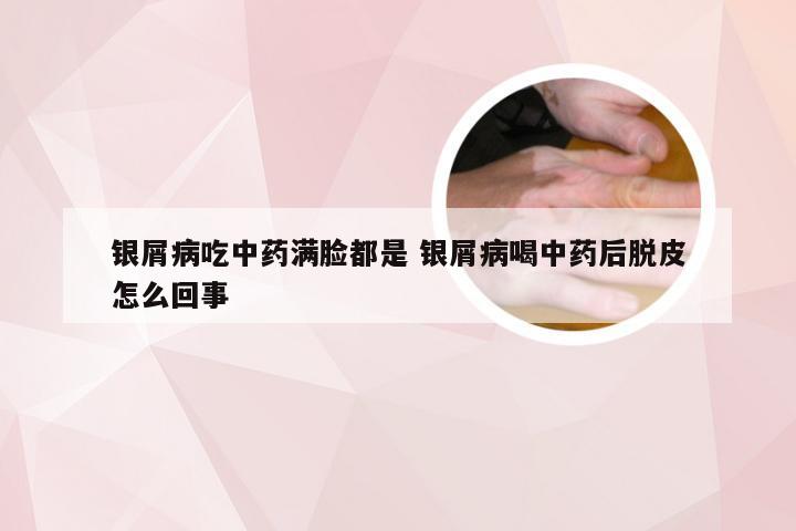 银屑病吃中药满脸都是 银屑病喝中药后脱皮怎么回事