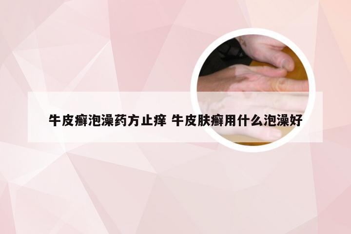 牛皮癣泡澡药方止痒 牛皮肤癣用什么泡澡好