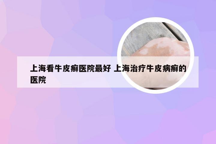 上海看牛皮癣医院最好 上海治疗牛皮病癣的医院