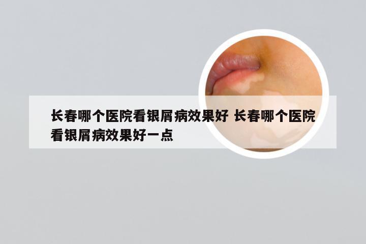 长春哪个医院看银屑病效果好 长春哪个医院看银屑病效果好一点