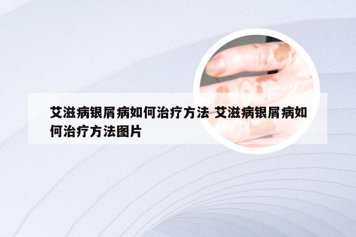 艾滋病银屑病如何治疗方法 艾滋病银屑病如何治疗方法图片