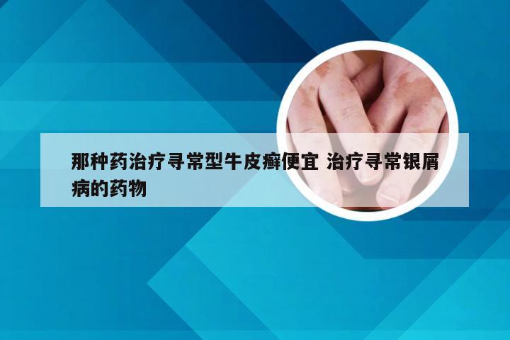 那种药治疗寻常型牛皮癣便宜 治疗寻常银屑病的药物