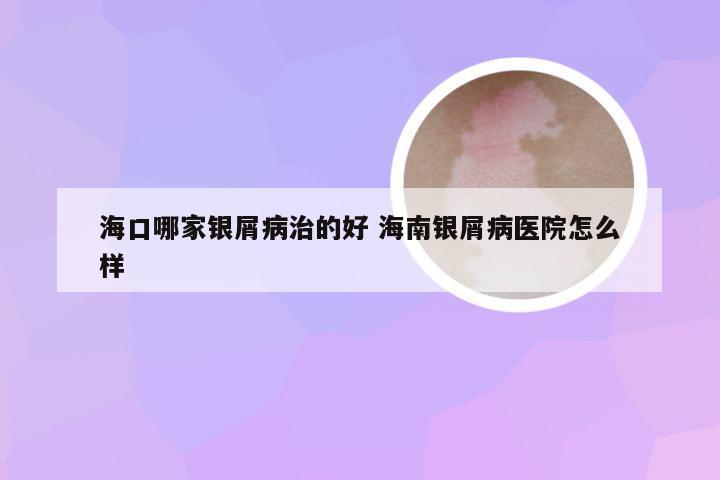 海口哪家银屑病治的好 海南银屑病医院怎么样