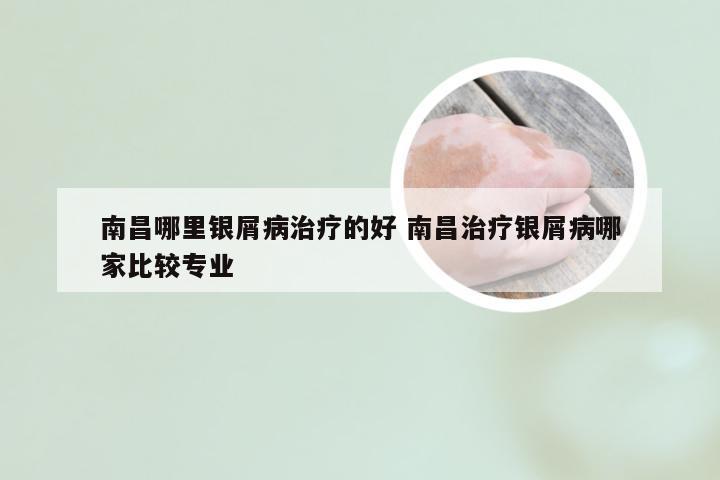 南昌哪里银屑病治疗的好 南昌治疗银屑病哪家比较专业