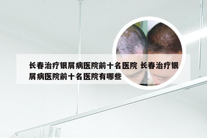 长春治疗银屑病医院前十名医院 长春治疗银屑病医院前十名医院有哪些