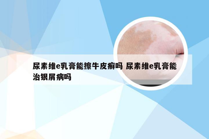 尿素维e乳膏能擦牛皮癣吗 尿素维e乳膏能治银屑病吗