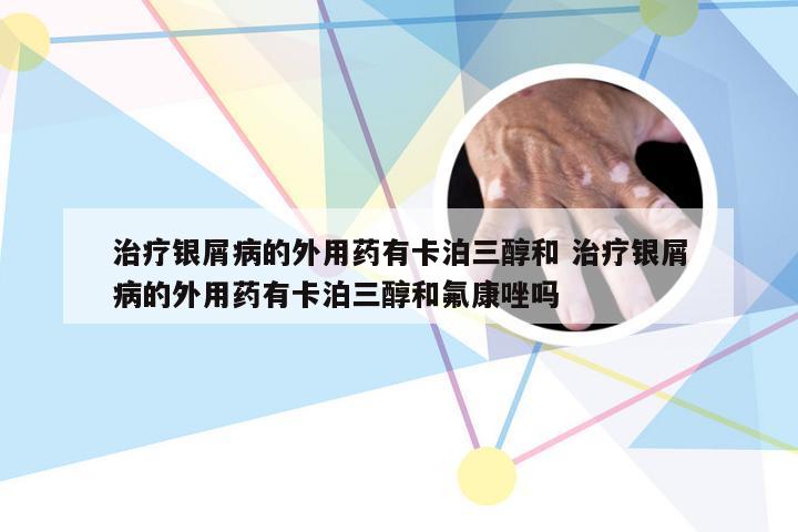 治疗银屑病的外用药有卡泊三醇和 治疗银屑病的外用药有卡泊三醇和氟康唑吗