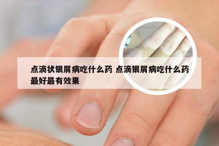 点滴状银屑病吃什么药 点滴银屑病吃什么药最好最有效果