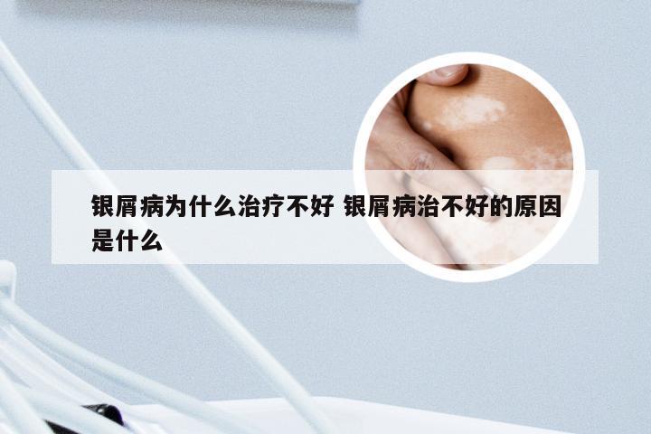 银屑病为什么治疗不好 银屑病治不好的原因是什么