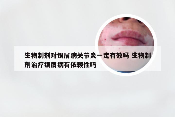 生物制剂对银屑病关节炎一定有效吗 生物制剂治疗银屑病有依赖性吗