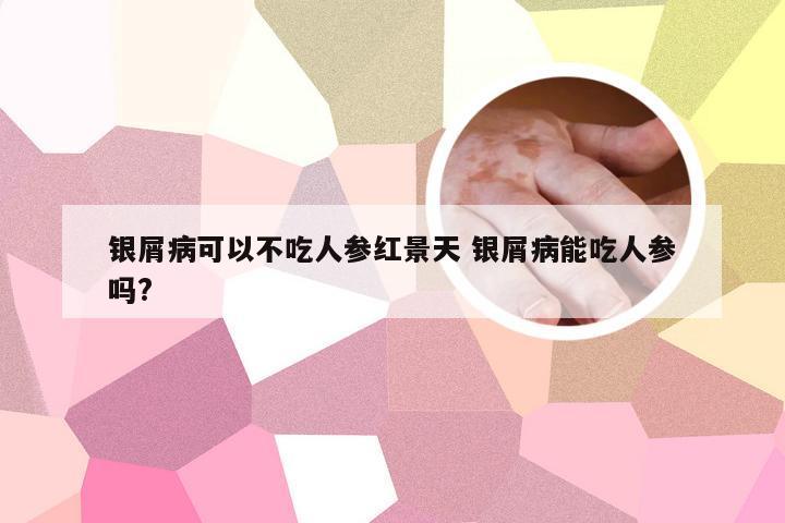 银屑病可以不吃人参红景天 银屑病能吃人参吗?