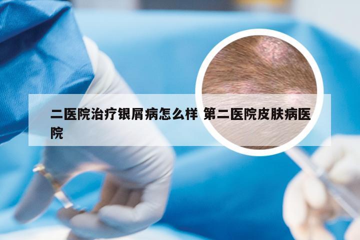 二医院治疗银屑病怎么样 第二医院皮肤病医院