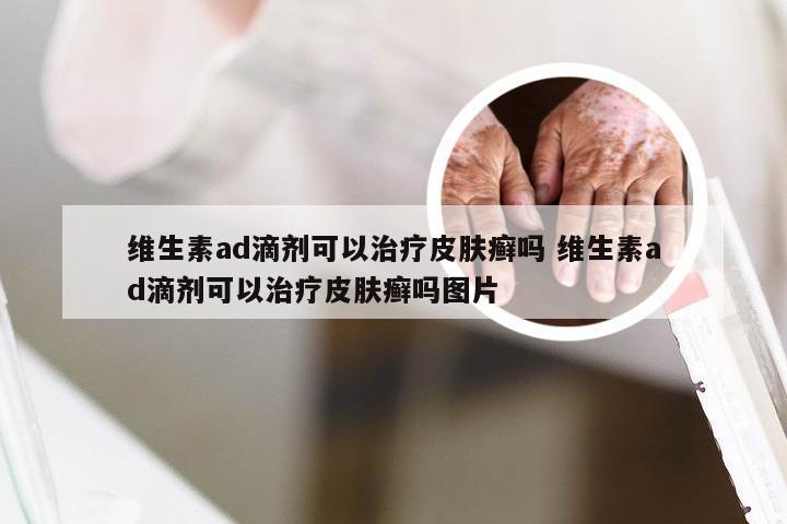 维生素ad滴剂可以治疗皮肤癣吗 维生素ad滴剂可以治疗皮肤癣吗图片