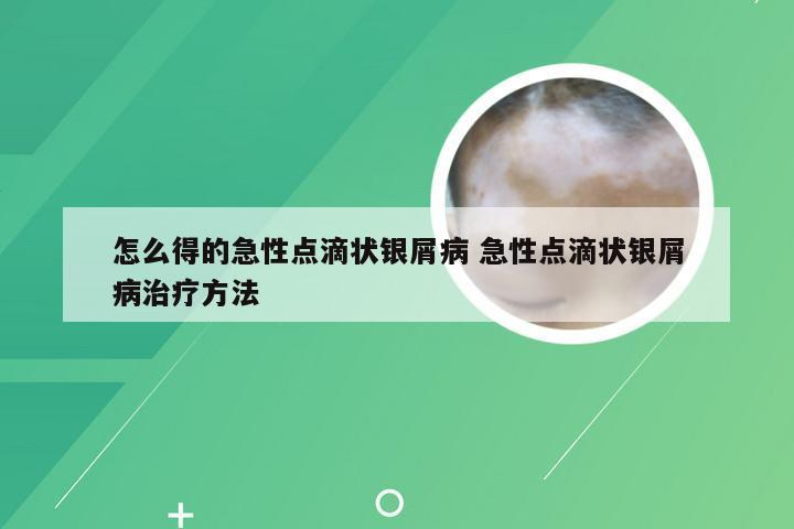 怎么得的急性点滴状银屑病 急性点滴状银屑病治疗方法