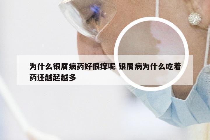 为什么银屑病药好很痒呢 银屑病为什么吃着药还越起越多