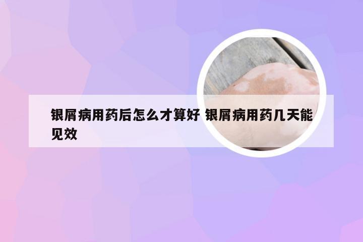 银屑病用药后怎么才算好 银屑病用药几天能见效