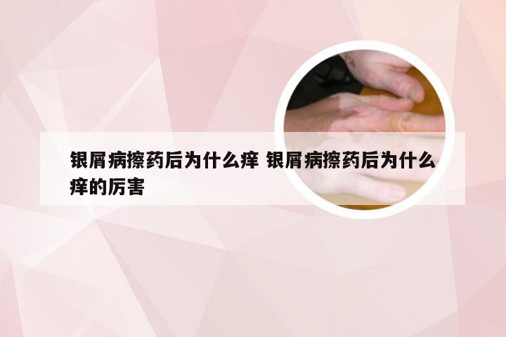 银屑病擦药后为什么痒 银屑病擦药后为什么痒的厉害