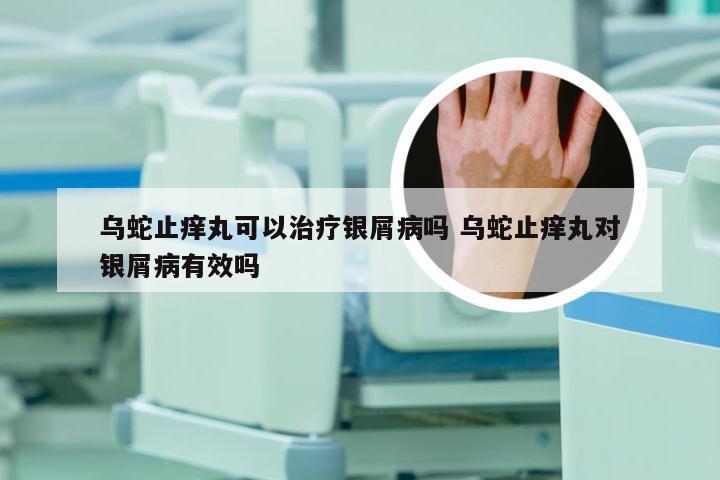 乌蛇止痒丸可以治疗银屑病吗 乌蛇止痒丸对银屑病有效吗