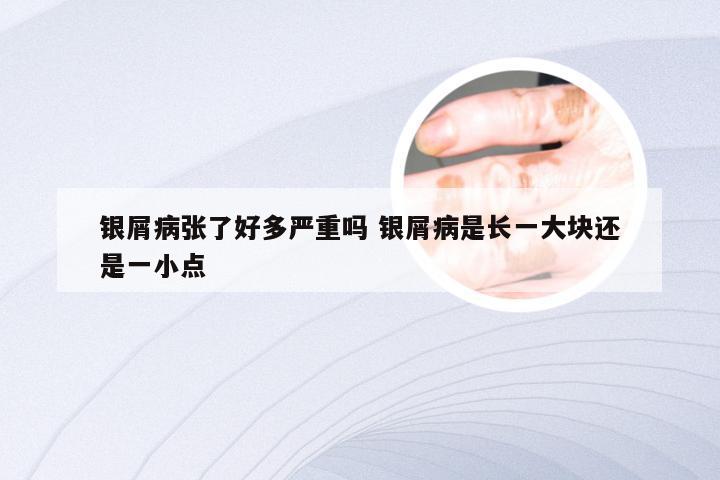 银屑病张了好多严重吗 银屑病是长一大块还是一小点