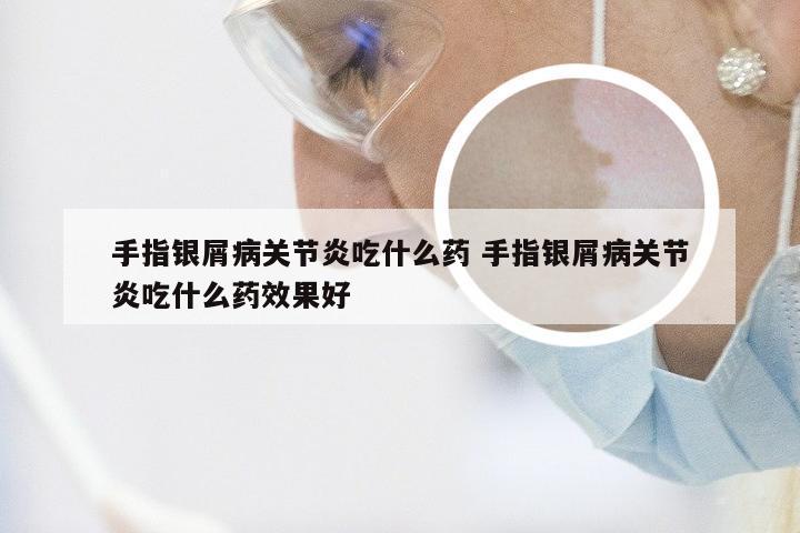 手指银屑病关节炎吃什么药 手指银屑病关节炎吃什么药效果好