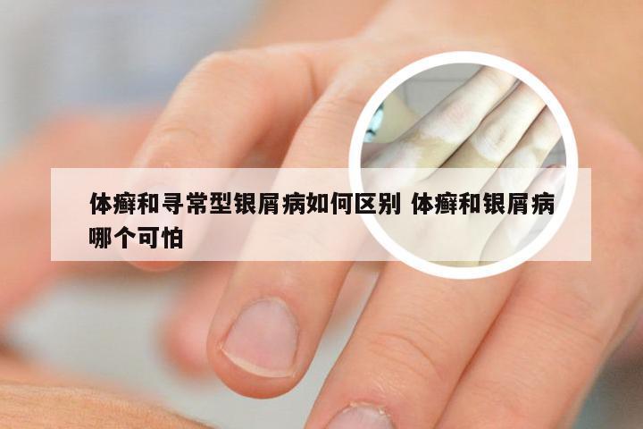 体癣和寻常型银屑病如何区别 体癣和银屑病哪个可怕