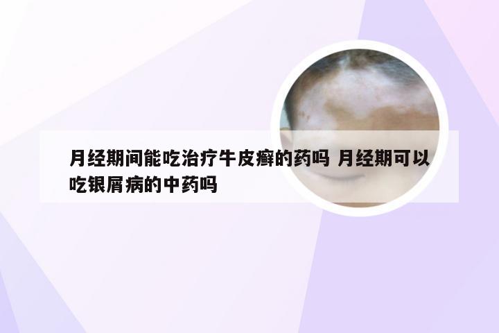 月经期间能吃治疗牛皮癣的药吗 月经期可以吃银屑病的中药吗