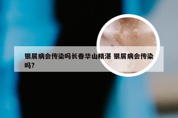 银屑病会传染吗长春华山精湛 银屑病会传染吗?