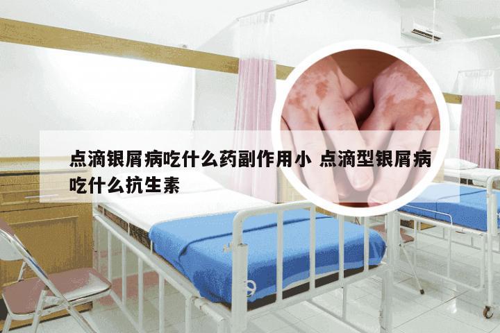 点滴银屑病吃什么药副作用小 点滴型银屑病吃什么抗生素