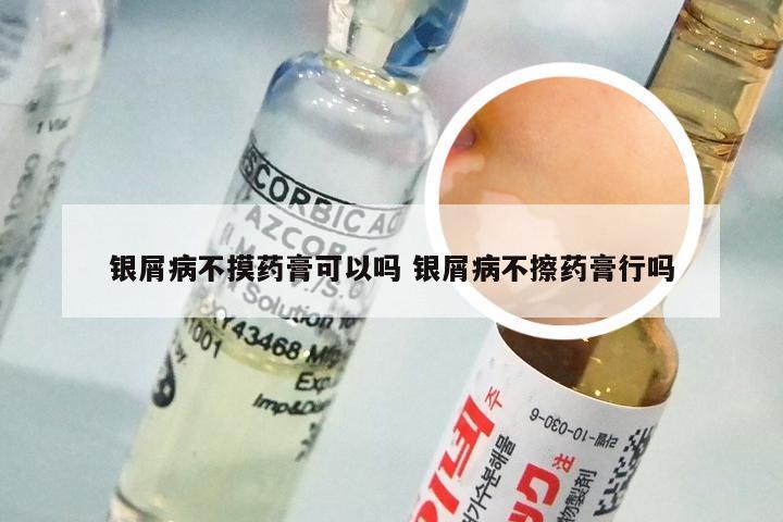 银屑病不摸药膏可以吗 银屑病不擦药膏行吗