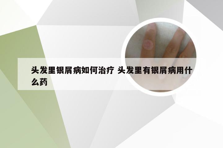 头发里银屑病如何治疗 头发里有银屑病用什么药