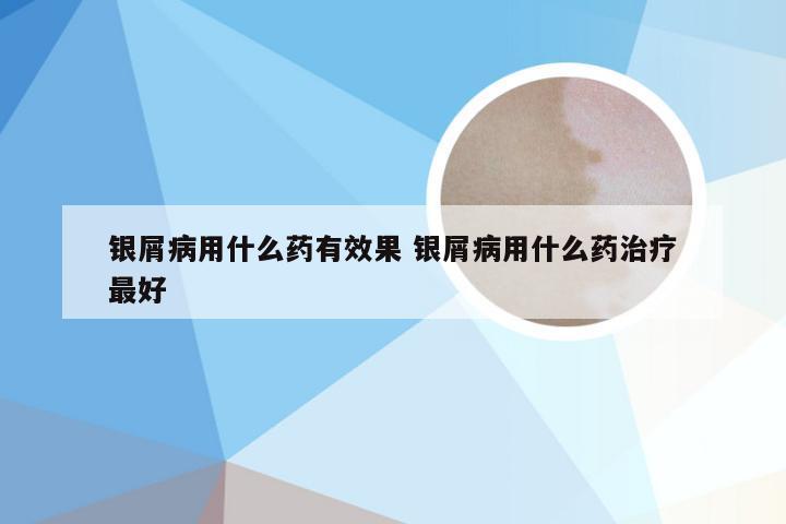 银屑病用什么药有效果 银屑病用什么药治疗最好