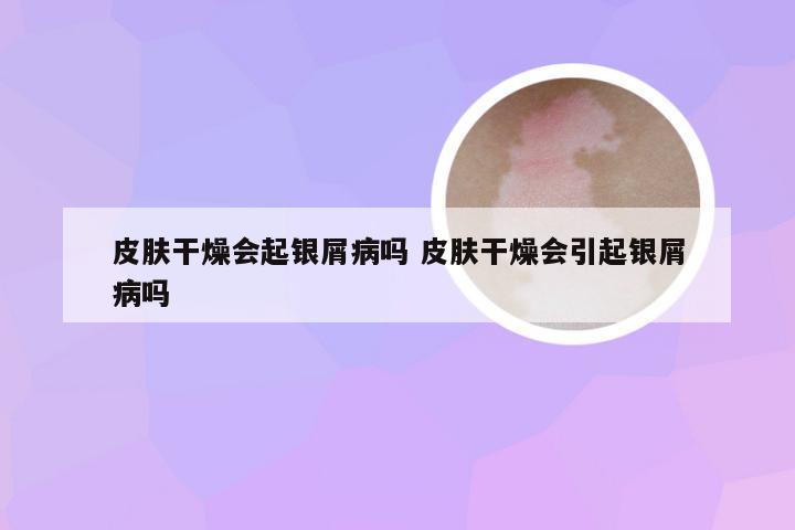 皮肤干燥会起银屑病吗 皮肤干燥会引起银屑病吗