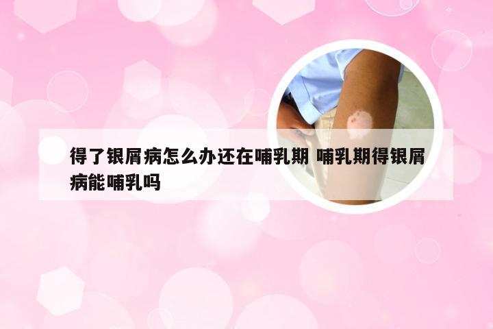 得了银屑病怎么办还在哺乳期 哺乳期得银屑病能哺乳吗