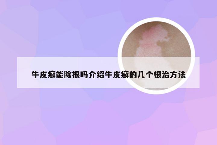 牛皮癣能除根吗介绍牛皮癣的几个根治方法