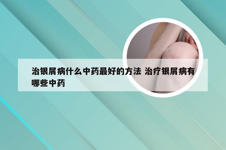 治银屑病什么中药最好的方法 治疗银屑病有哪些中药